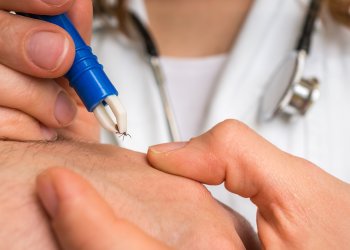 Female doctor removing a tick with tweezers from hand of patient to prevent tick-borne disease - Encephalitis, borreliosis and lyme disease.